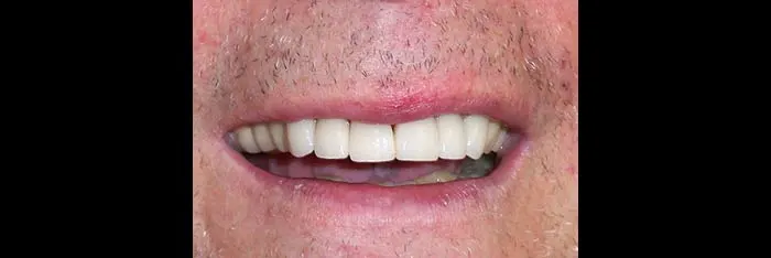 Veneers after