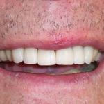 Veneers after