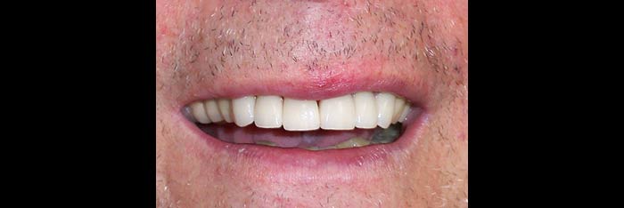 Veneers after