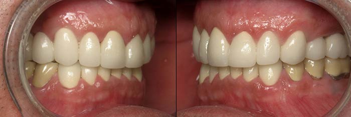 Full Mouth Reconstruction After