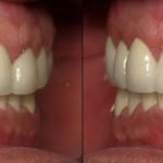 Full Mouth Reconstruction After
