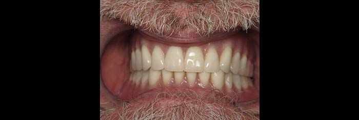 Dentures in Place