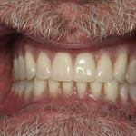 Dentures in Place