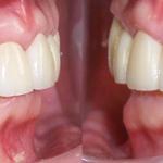 Veneers after