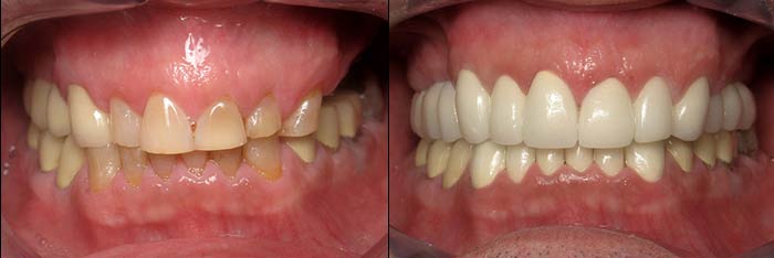 Full Mouth Reconstruction Before and After