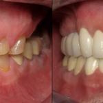 Full Mouth Reconstruction Before and After