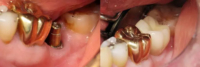 Before | After Implants