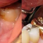 Before | After Implants