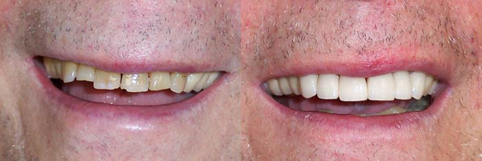 Veneers Before and After