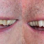Veneers Before and After