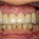 Hidden clasps on upper partial. Conventional clasps on lower partial