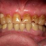 Full Mouth Reconstruction Before
