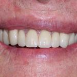 Crowns with Partial