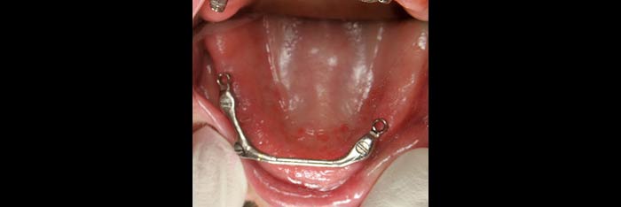 Upper Tissue Bar