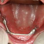 Upper Tissue Bar