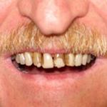 Veneers before