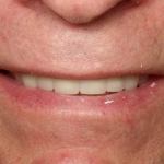 Full Mouth Reconstruction After