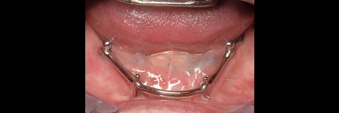 Lower Tissue Bar