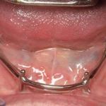 Lower Tissue Bar
