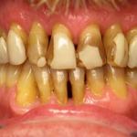 Veneers before