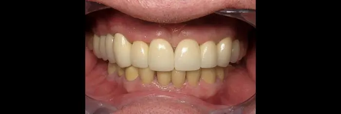 Full Mouth Reconstruction After
