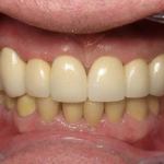 Full Mouth Reconstruction After