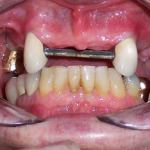 Crowns with Attachments