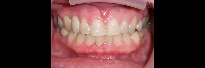 After Implants