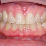 After Implants