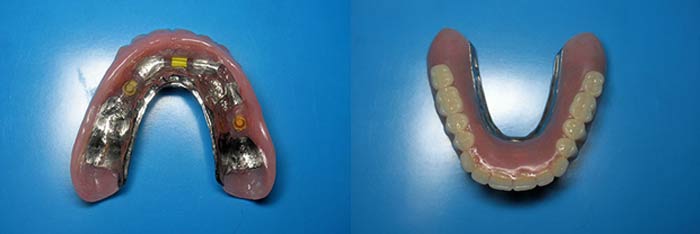 Upper Denture