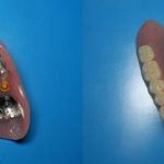 Upper Denture