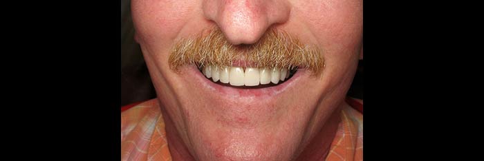 Veneers after