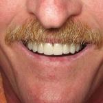 Veneers after