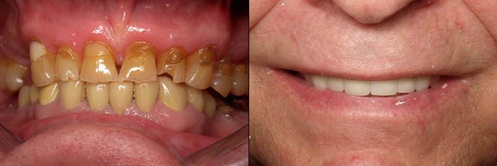 Full Mouth Reconstruction Before and After