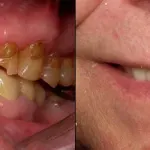 Full Mouth Reconstruction Before and After