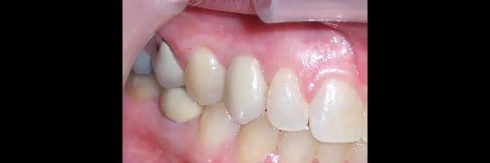After Implants