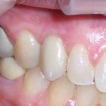 After Implants