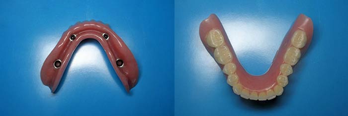 Lower Denture