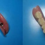 Lower Denture