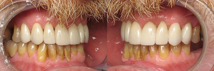 Veneers after