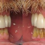 Veneers after