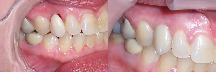 Before | After Implants