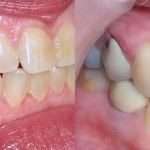 Before | After Implants