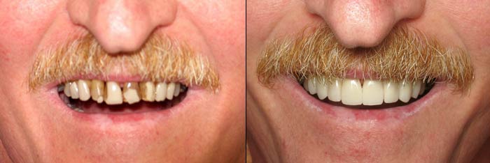 Veneers Before and After