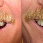 Veneers Before and After