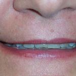 Veneers before