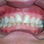 Veneers before