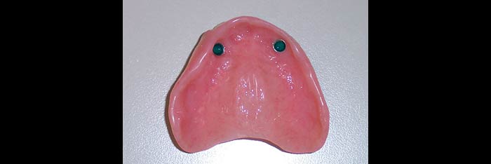 Upper Denture