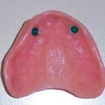 Upper Denture