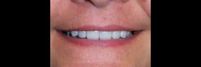 Veneers after